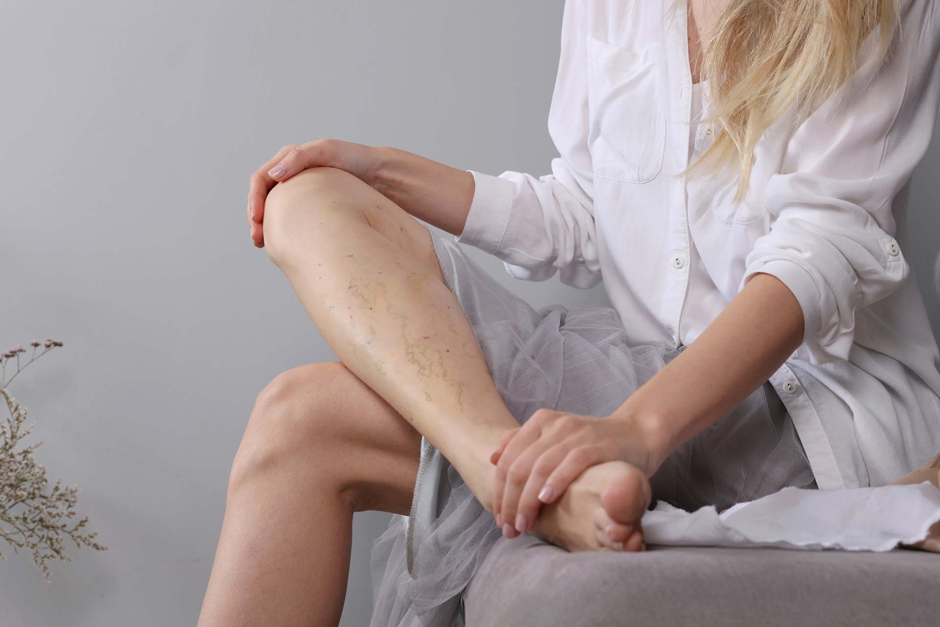 What are Spider Veins, and Should You Be Worried About Them?