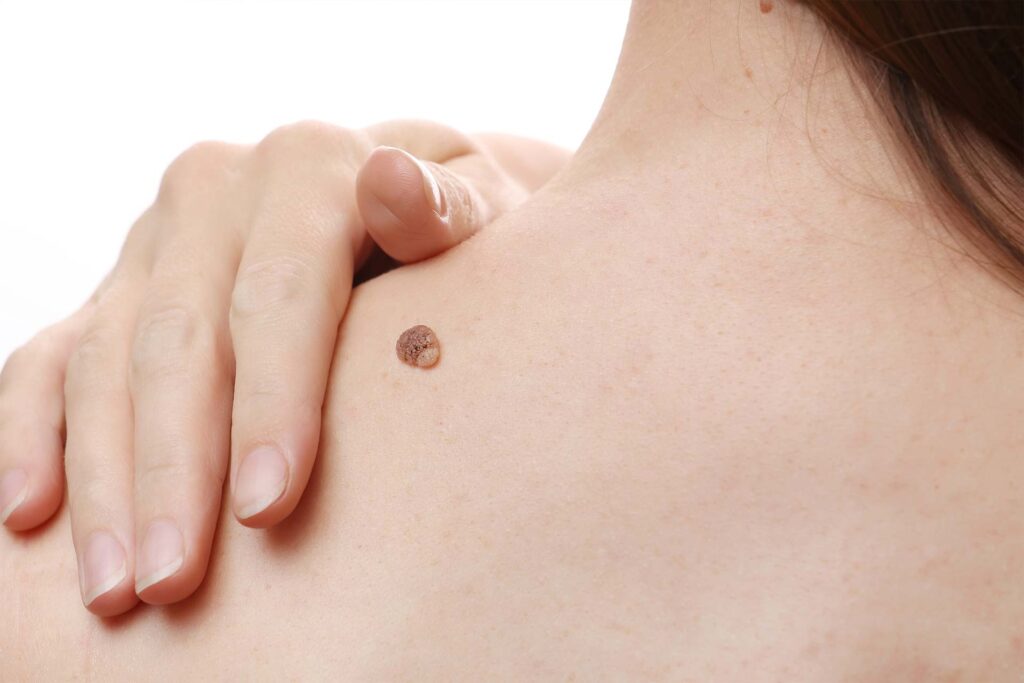 The Many Causes of Skin Warts and How to Treat Them