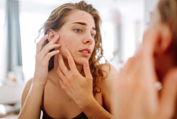 Understanding the Role of Hormones in Acne and How to Manage It