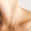 Preventing and Treating Hyperpigmentation: Tips for Even Looking, Clean Skin