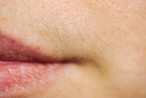 laser caused hair growth: why it happens and how to solve it