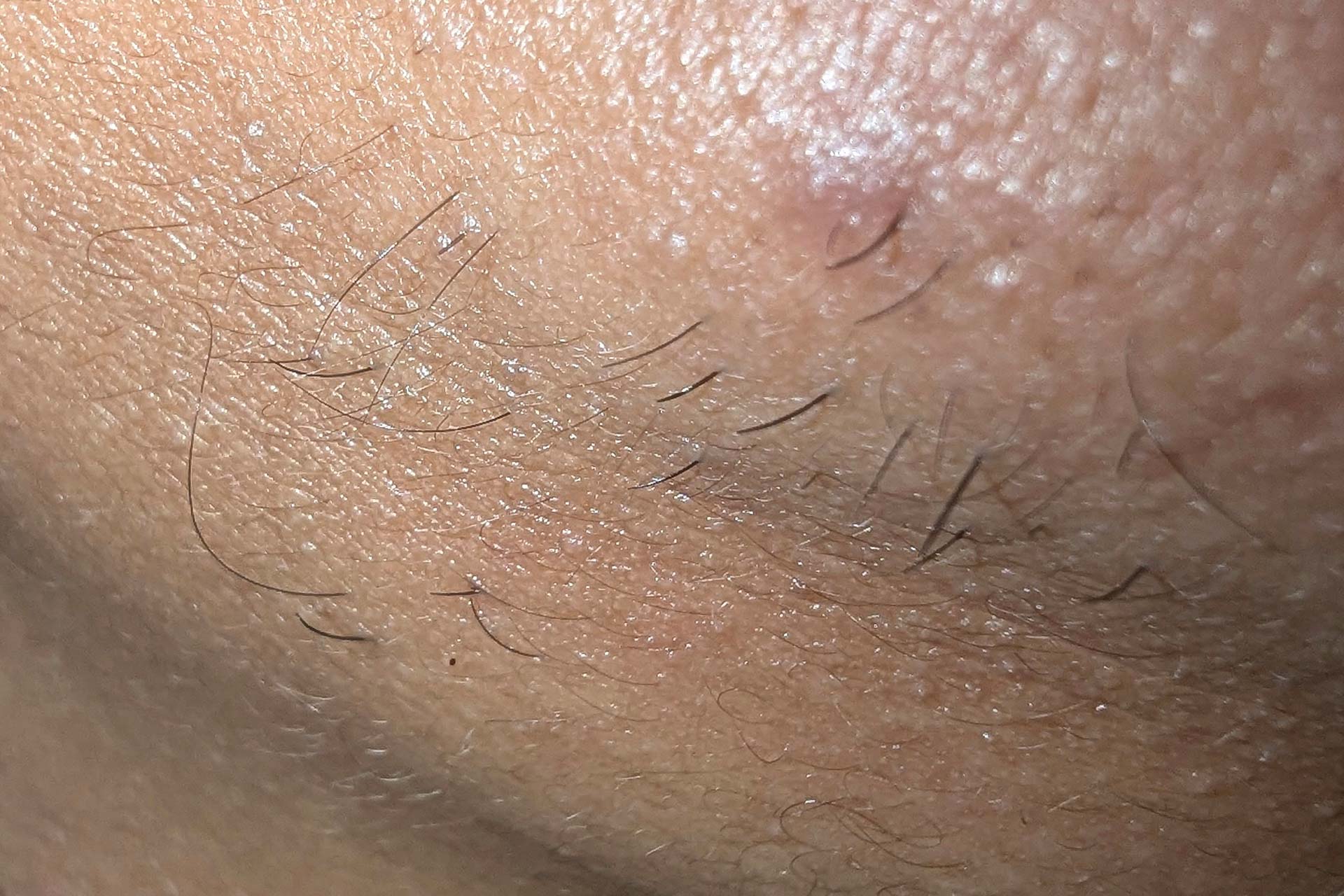 PCOS Facial Hair Removal: Why Electrolysis Works When Other Methods Fail