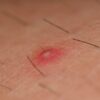 folliculitis-treatment | Jade Clinics Folliculitis Treatment for Recurring Cases