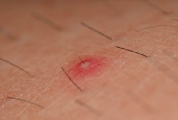 folliculitis-treatment | Jade Clinics Folliculitis Treatment for Recurring Cases