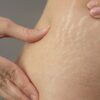 stretch-marks | Jade Clinics Can Stretch Marks Be Treated?