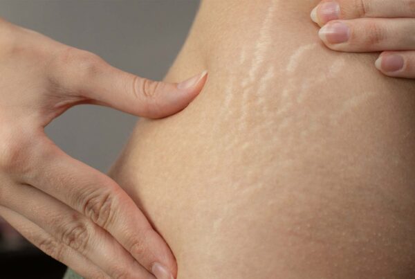 Can Stretch Marks Be Treated?