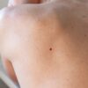 cherry angioma