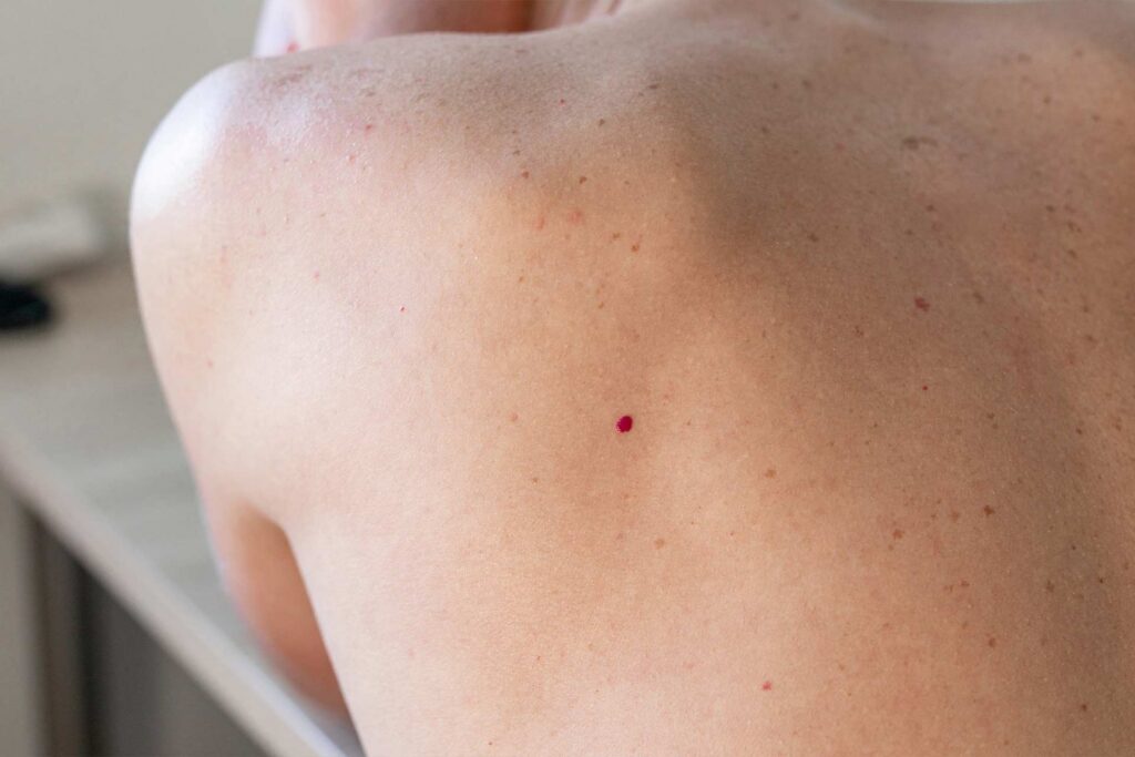 cherry angioma