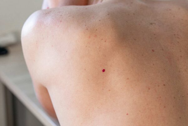 cherry angioma