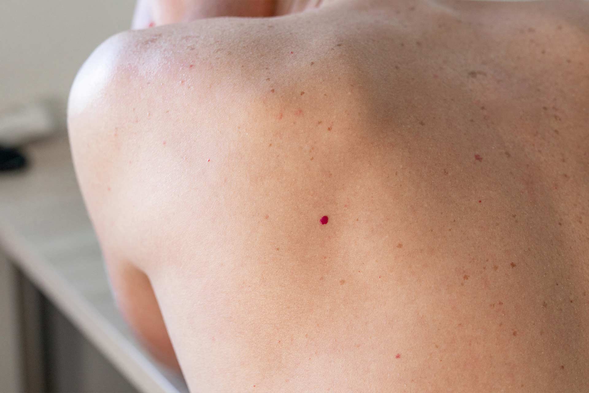 cherry angioma